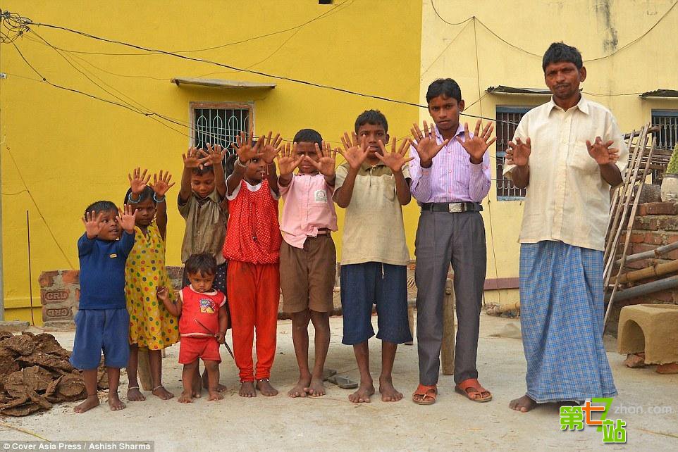 印度一家族25口人均有六指六趾 总共600只