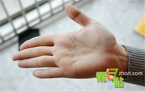 少女双手常年滴水 居然跟她的胸有关！